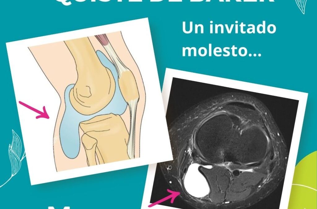 Quiste de Baker, un invitado molesto. Causas, síntomas y tratamiento en Madrid