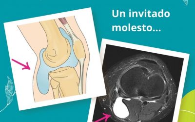 Quiste de Baker, un invitado molesto. Causas, síntomas y tratamiento en Madrid