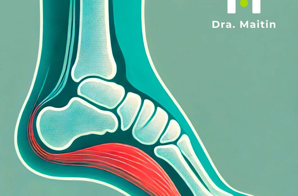 Fascitis plantar: causas, síntomas, diagnóstico y tratamiento en Madrid