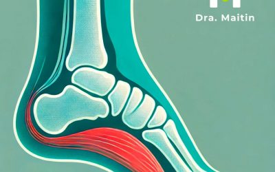 Fascitis plantar: causas, síntomas, diagnóstico y tratamiento en Madrid